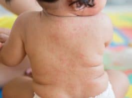 انخفاض حاد بنسبة 80% في حالات «بوحمرون» بالمغرب انخفاض حاد بنسبة 80% في حالات "بوحمرون" بالمغرب