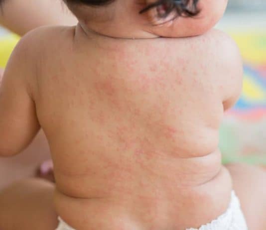 انخفاض حاد بنسبة 80% في حالات «بوحمرون» بالمغرب انخفاض حاد بنسبة 80% في حالات "بوحمرون" بالمغرب